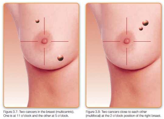 Get the Facts - Mastectomy & Reconstruction - Reclaim Your ...